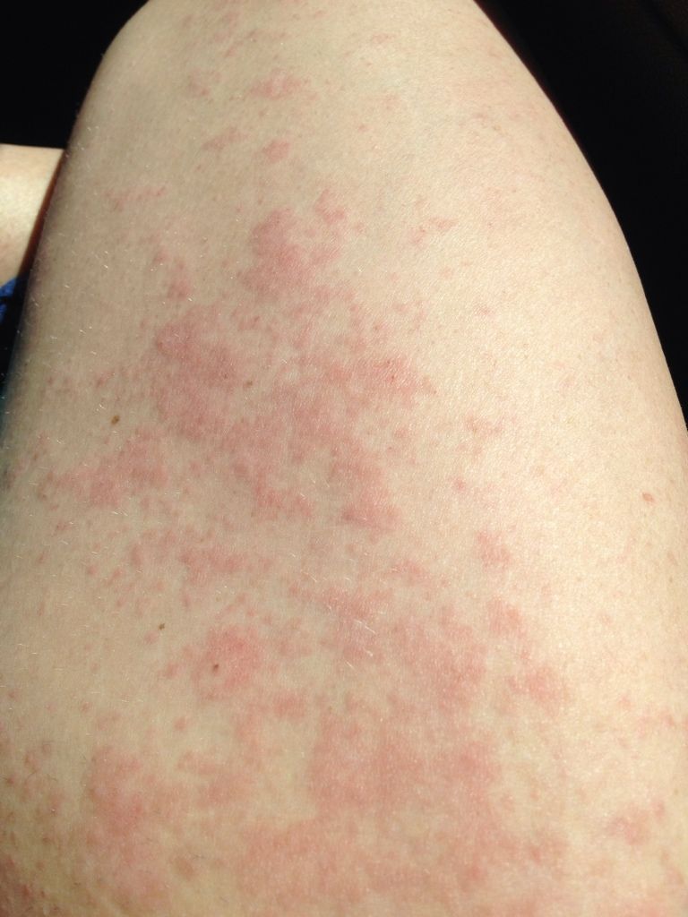 hives on legs #9
